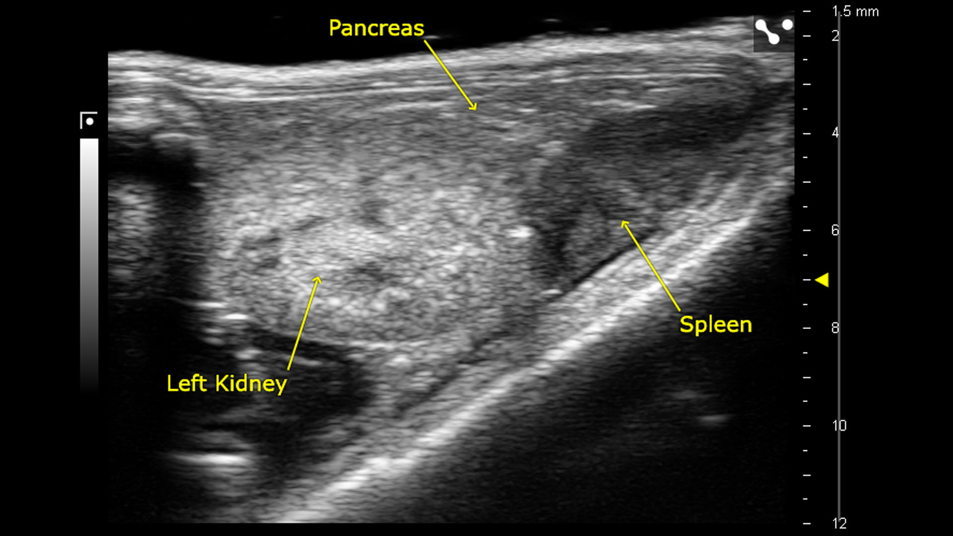 Left kidney spleen and pancreas fujifilm visualsonics